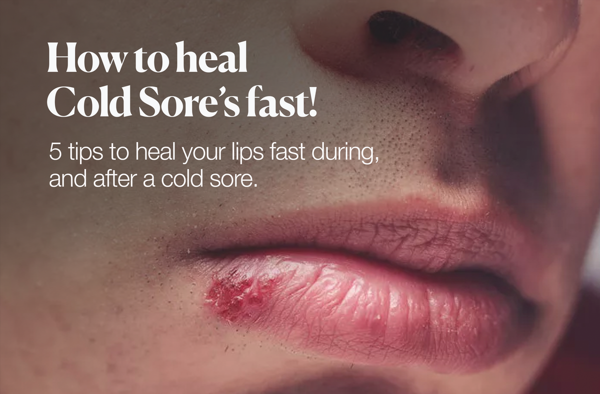 How to help heal Cold Sores fast! – Cold Sore Shield